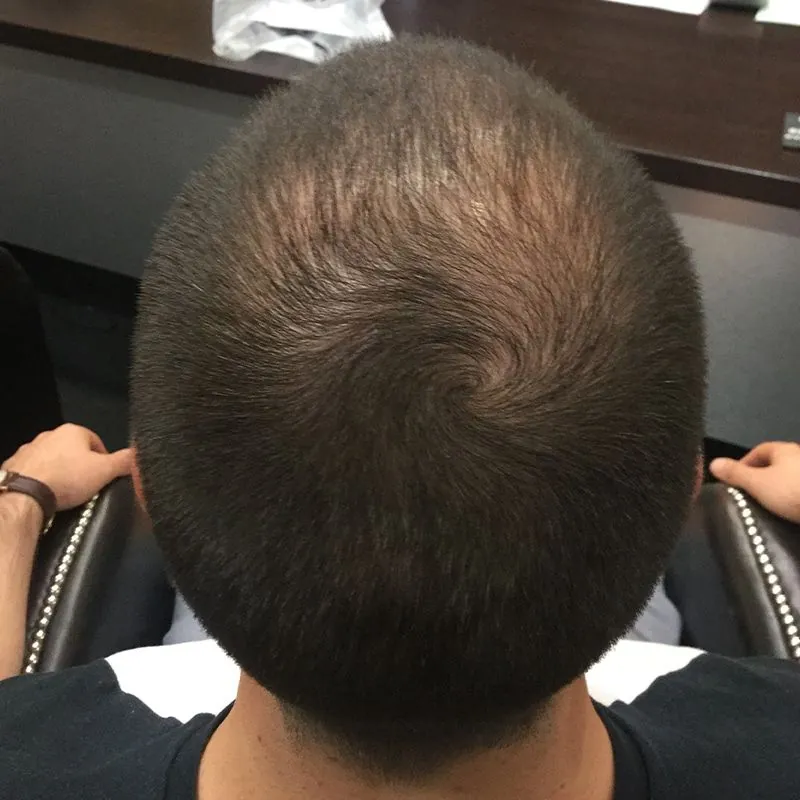 Client 08 before laser hair growth therapy