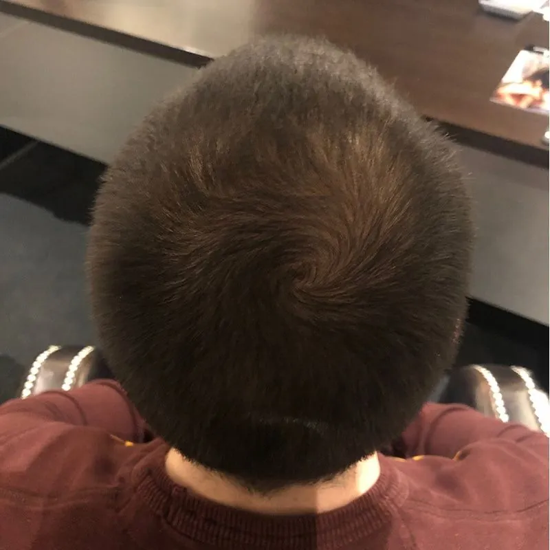 Client 08 after laser hair growth therapy