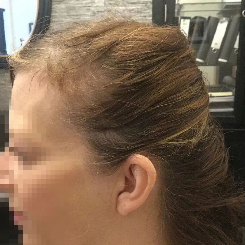 Client 11 before laser hair growth therapy