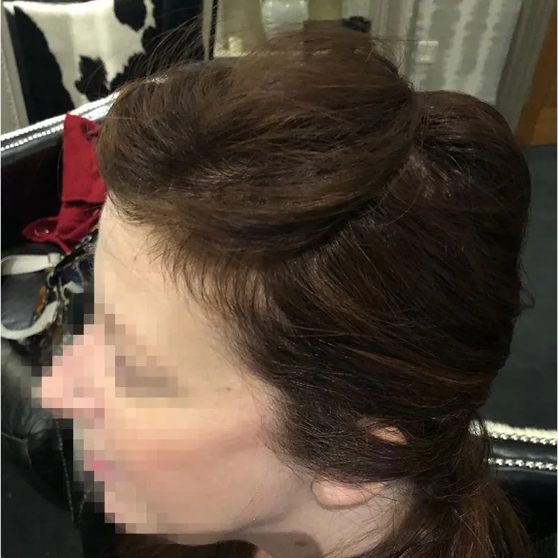 Client 11 after laser hair growth therapy
