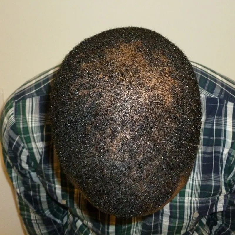 Client 04 before laser hair growth therapy