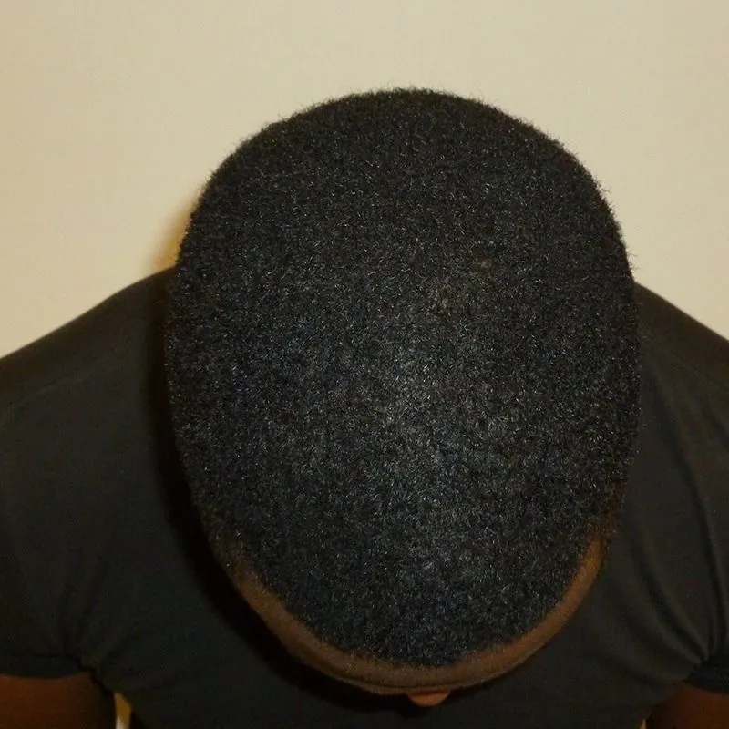 Client 04 after laser hair growth therapy
