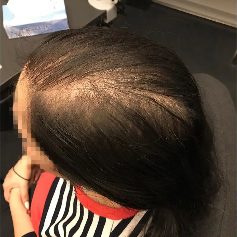Client 09 before laser hair growth therapy