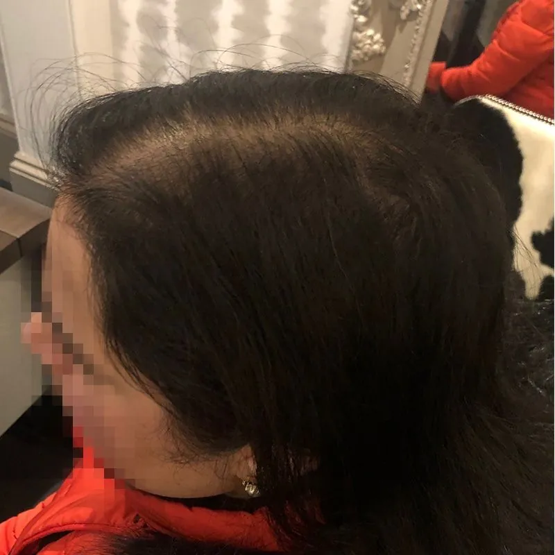 Client 09 after laser hair growth therapy