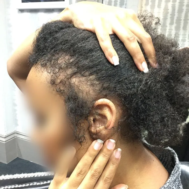 Client 03 before laser hair growth therapy