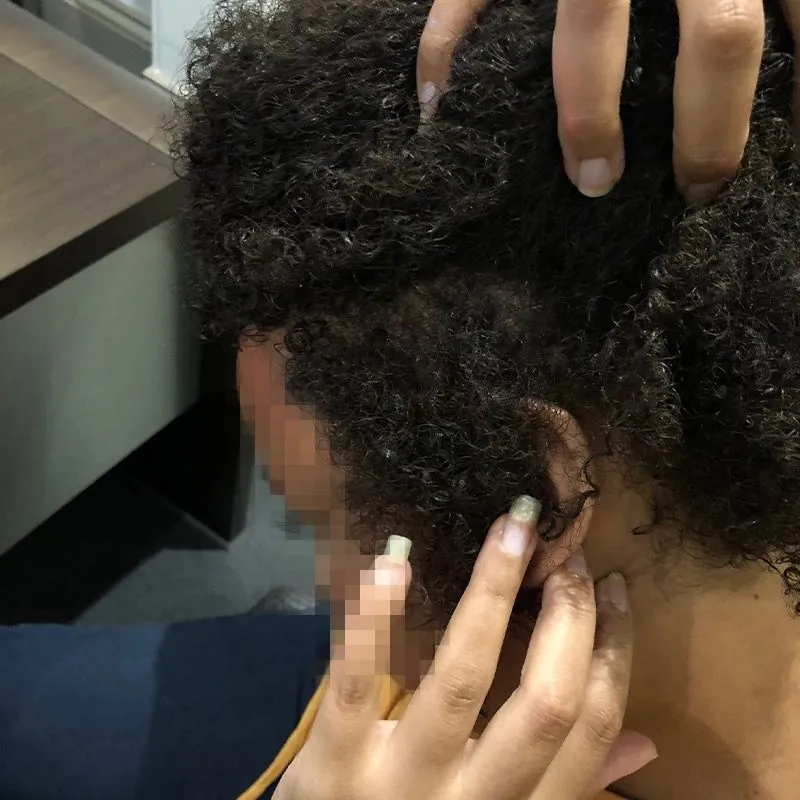 Client 10 after laser hair growth therapy