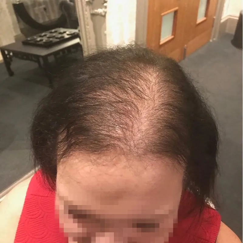 Client 12 before laser hair growth therapy