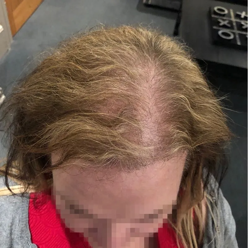 Client 12 after laser hair growth therapy