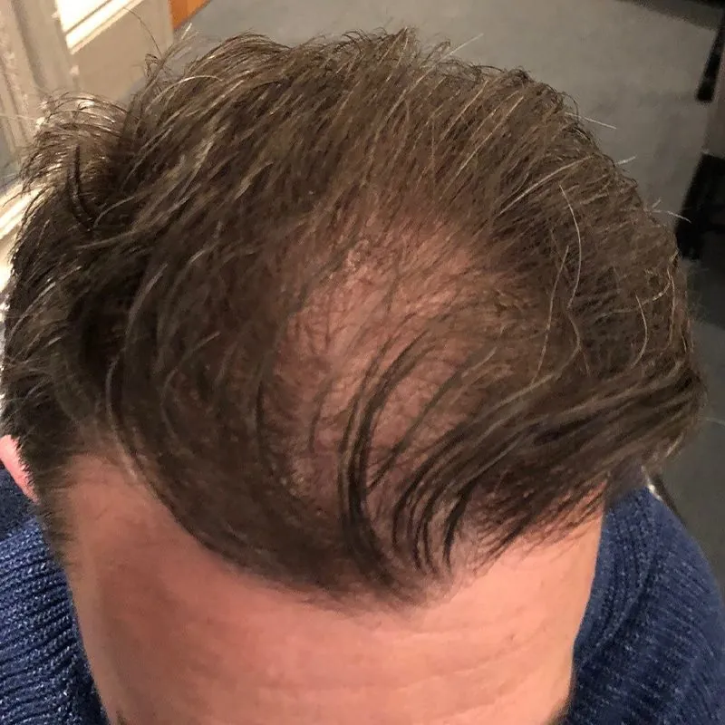 Client 05 before laser hair growth therapy