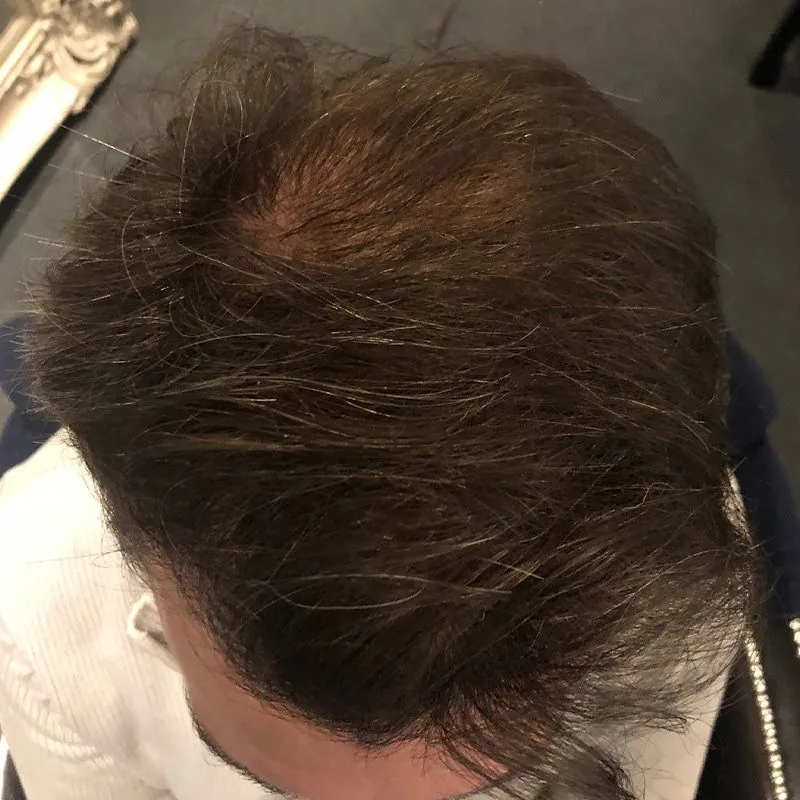 Client 05 after laser hair growth therapy