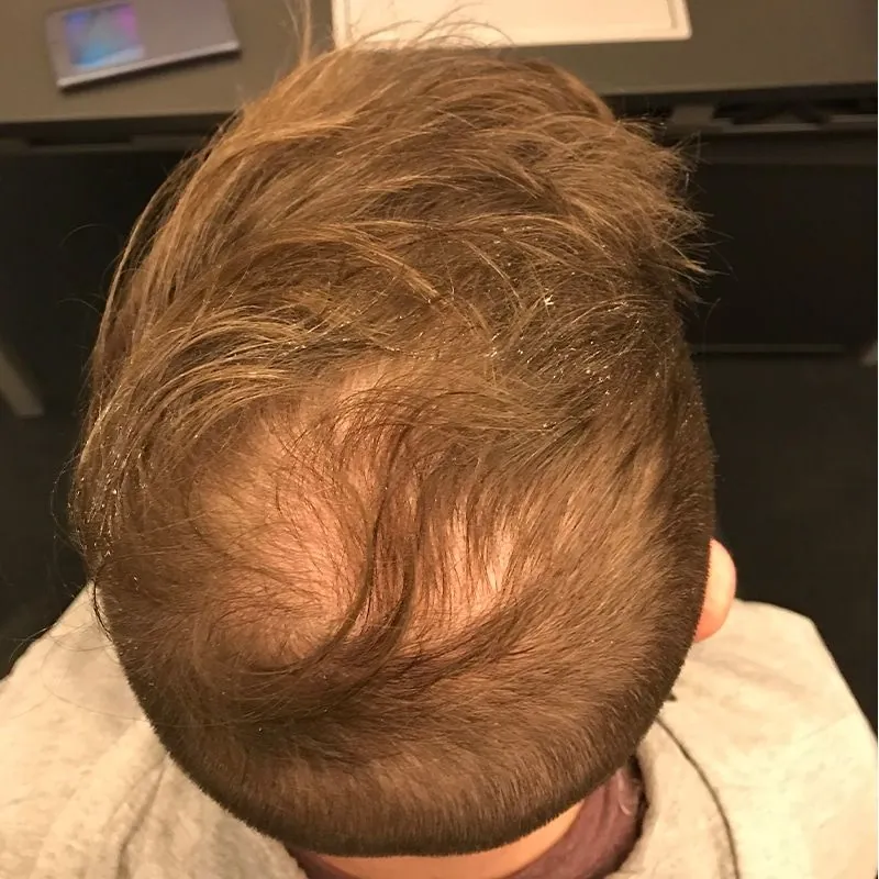 Client 06 before laser hair growth therapy
