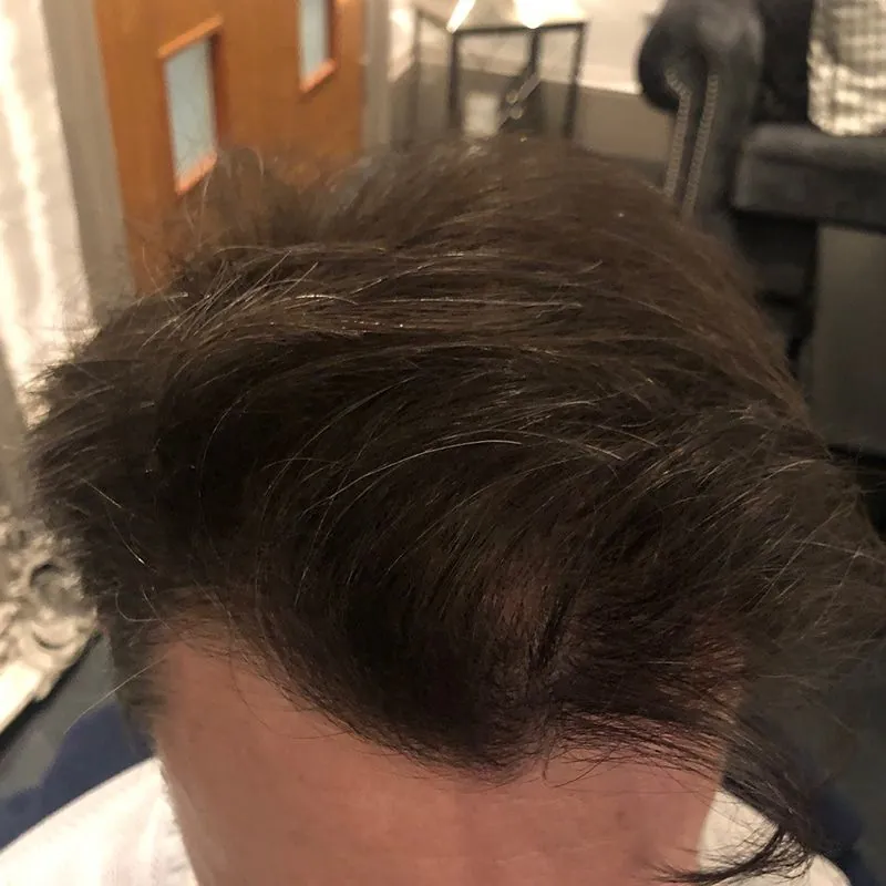 Client 05 after laser hair growth therapy
