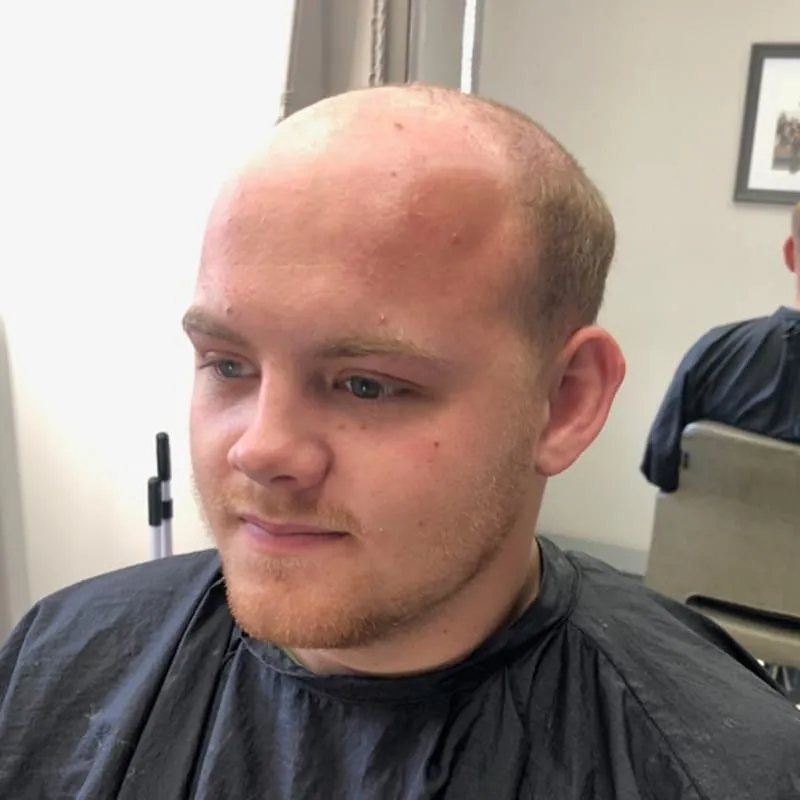 Client 06 before their hair system