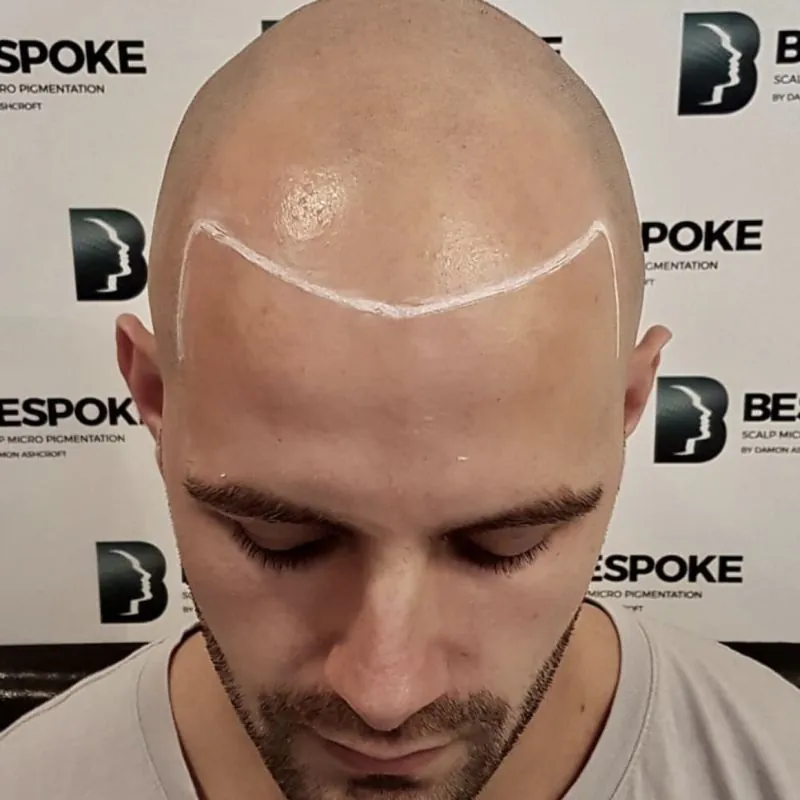 Client 01 before scalp micropigmentation