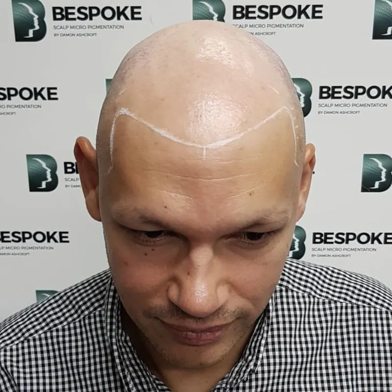 Client 03 before scalp micropigmentation