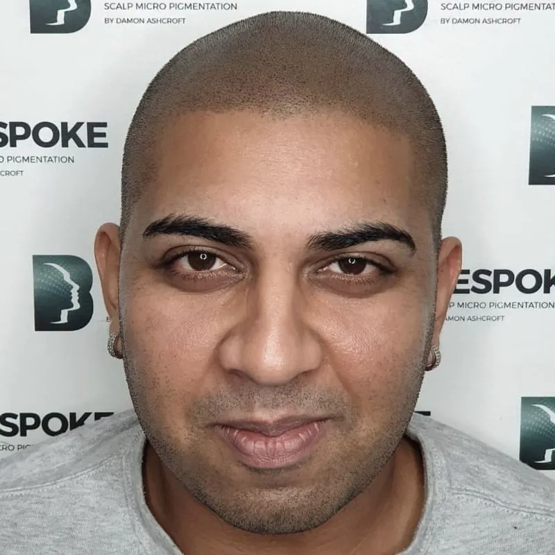 Client 06 after scalp micropigmentation