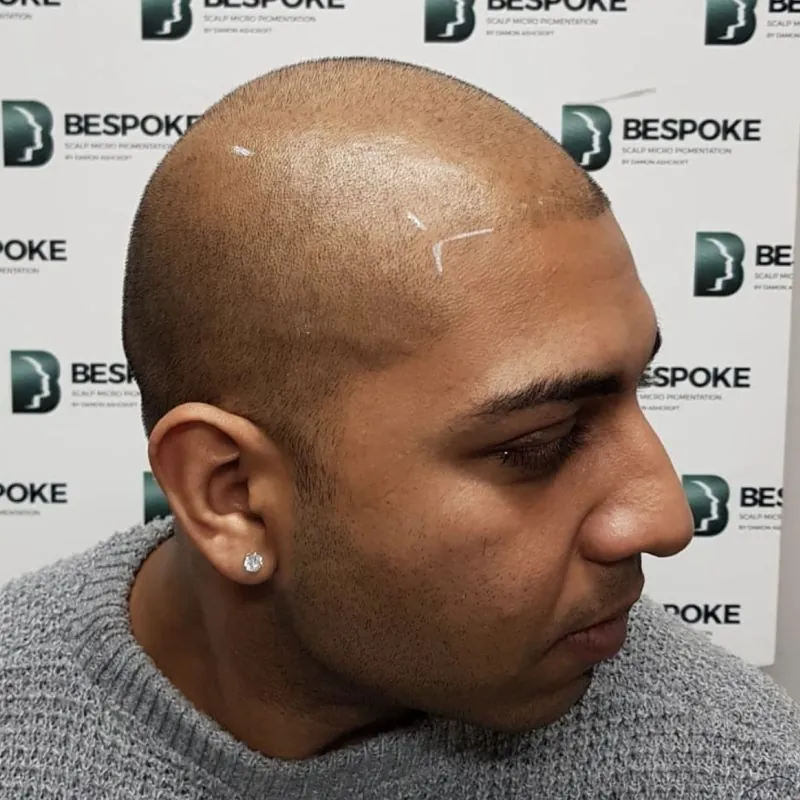 Client 02 before scalp micropigmentation