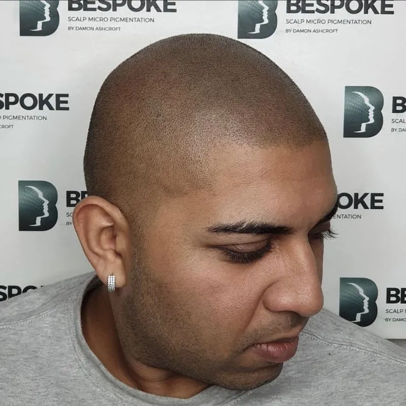 Client 02 after scalp micropigmentation