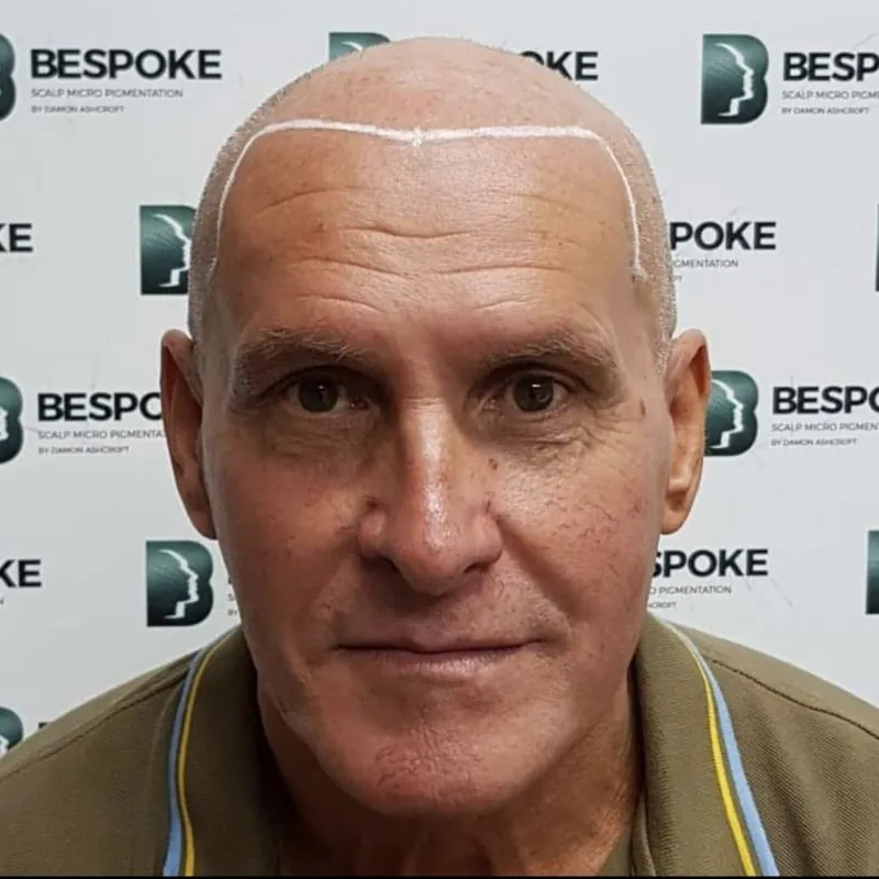 Client 05 before scalp micropigmentation