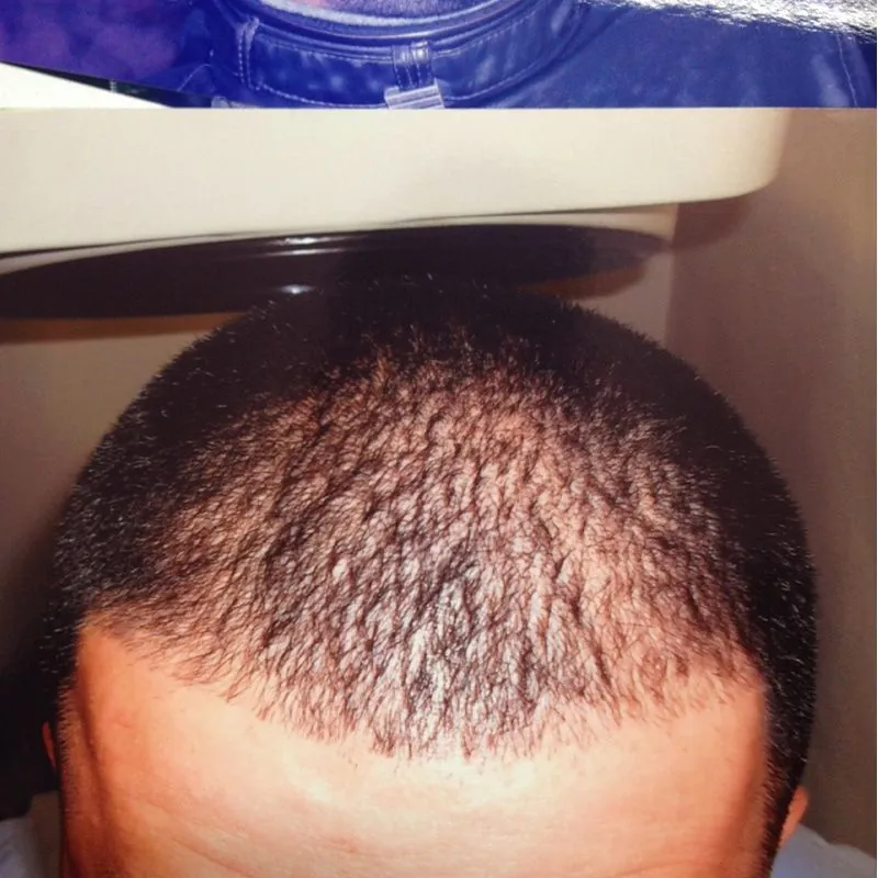 Client 03 before laser hair growth therapy