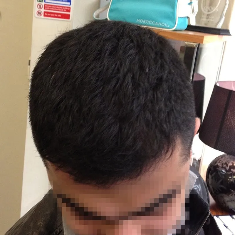 Client 03 after laser hair growth therapy