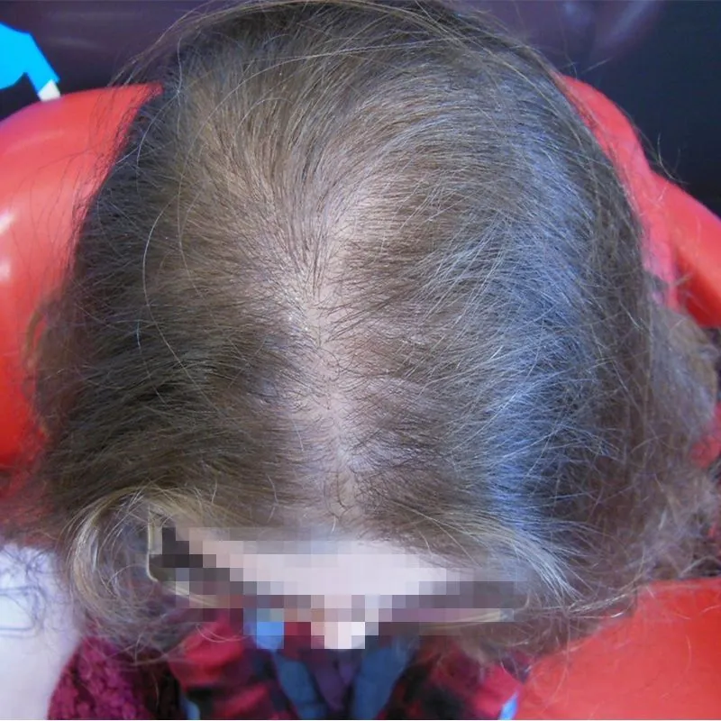 Client 02 before laser hair growth therapy