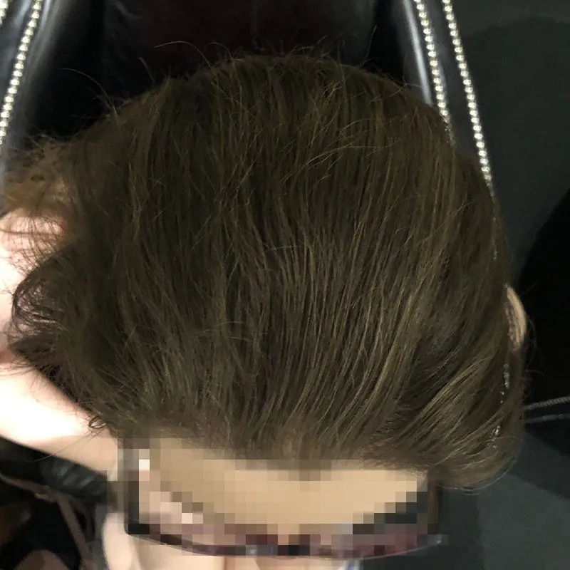 Client 02 after laser hair growth therapy