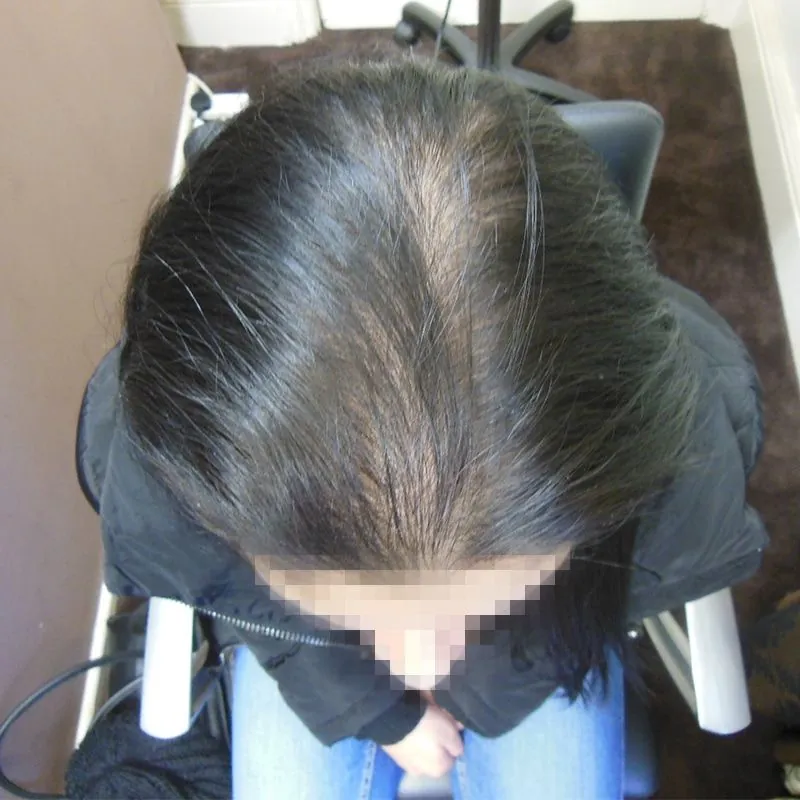Client 01 before laser hair growth therapy