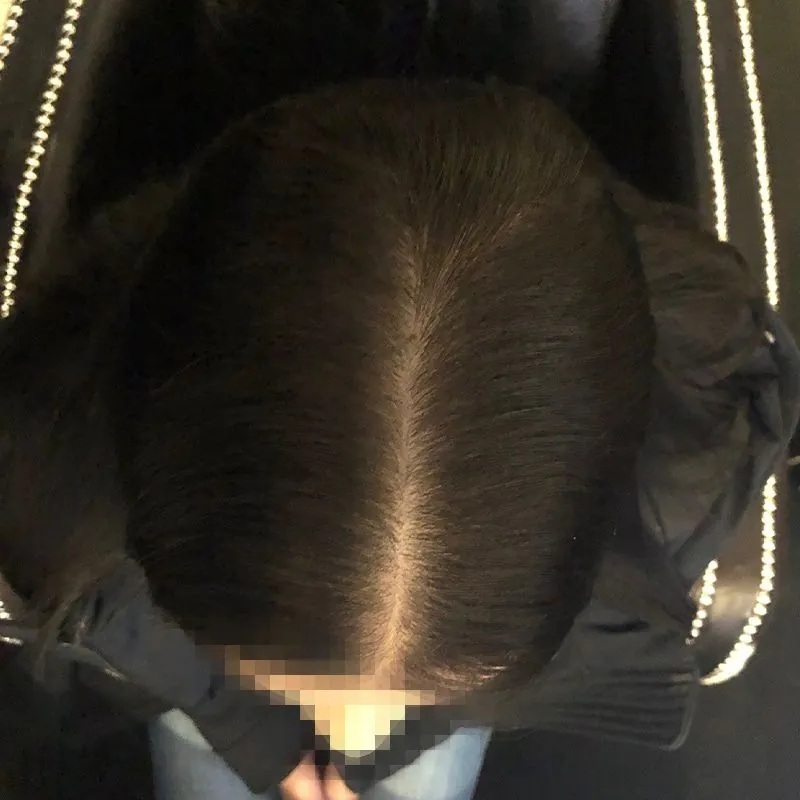 Client 01 after laser hair growth therapy