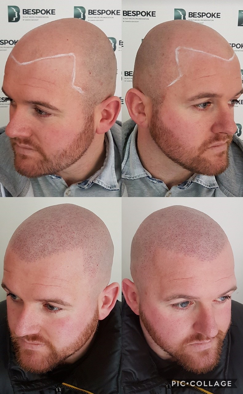 Hair Tatto For Receding Hairline